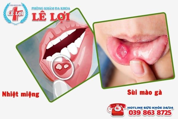 Sùi mào gà ở miệng và nhiệt miệng có gì khác nhau