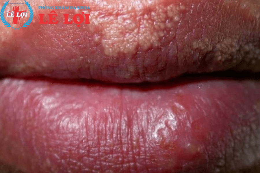 Triệu chứng của sùi mào gà ở môi - Mọc mụn nhỏ li ti ở môi